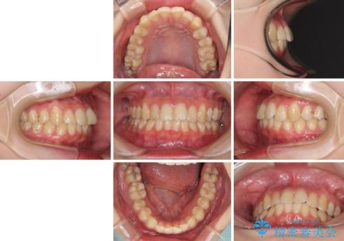 軽度な後戻りをインビザライン・ライトで改善の治療前