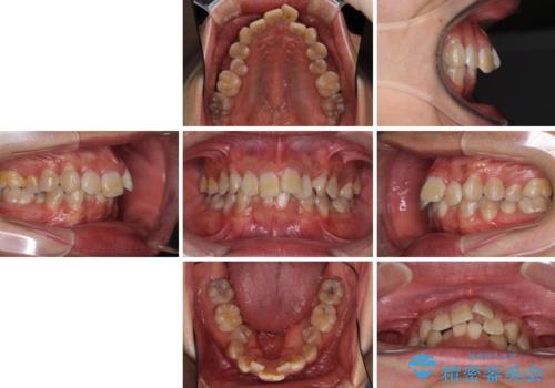 口元の突出感と叢生 ワイヤー装置による抜歯矯正の治療前