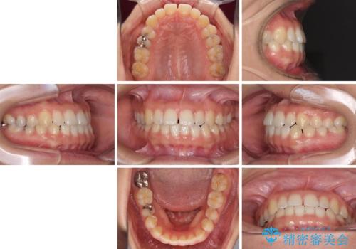 前歯の隙間を閉じたい　短期間でのワイヤー矯正の治療前