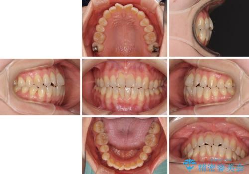 前歯の叢生と切端咬合 インビザラインによる矯正治療の治療前