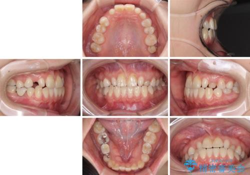 欠損と残存乳歯 矯正治療とインプラント治療の治療前