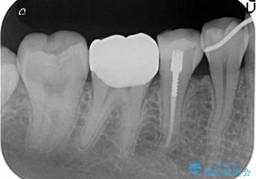 目立つ銀歯を白くしたい セラミック治療の治療後