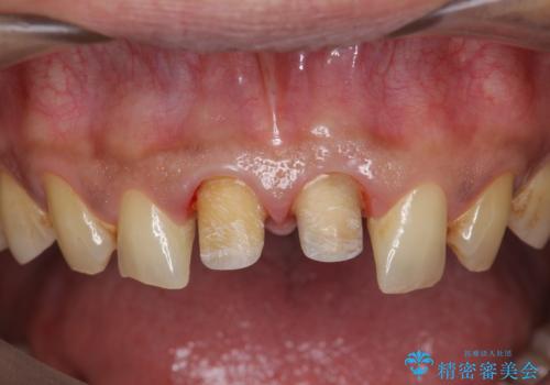 歯ぐきからの出血 膿が出る 前歯根管・セラミック治療の治療中