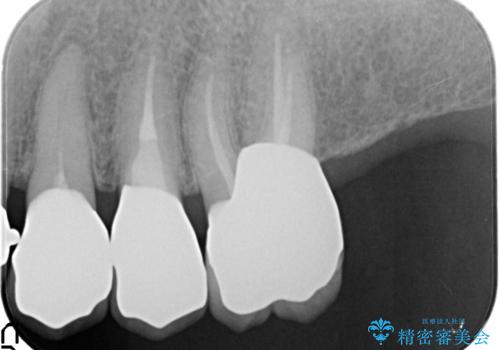 奥歯がなくてかめない 入れ歯とクラウンでの全顎治療の治療後