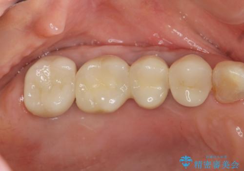 [ 歯牙破折 ]  インプラントによる咬合機能回復の治療後