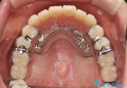 歯周病 インプラントによる咬合機能回復の治療後