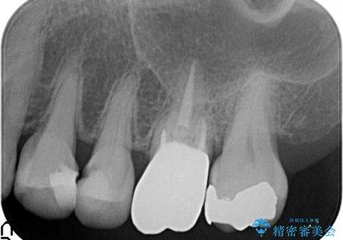 発見の難しい虫歯。根管治療から被せもの治療の治療後