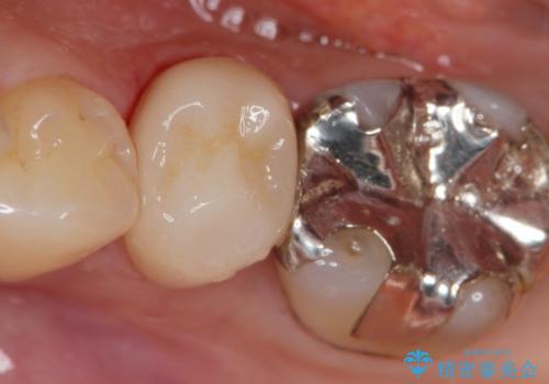 銀歯が外れ、内部に大きな虫歯の再発の治療後