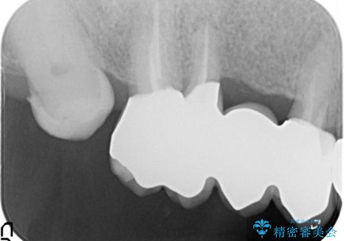 奥歯がなくてかめない 入れ歯とクラウンでの全顎治療の治療後