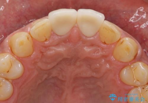 歯ぐきからの出血　膿が出る 前歯根管・セラミック治療の治療後