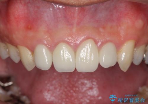 [根管治療・セラミック補綴]  歯ぐきを押すと痛いの治療前