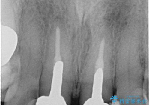 奥歯がなくてかめない 入れ歯とクラウンでの全顎治療の治療前