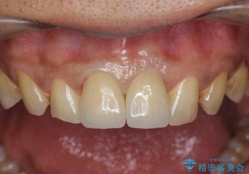 歯ぐきからの出血 膿が出る 前歯根管・セラミック治療の治療後