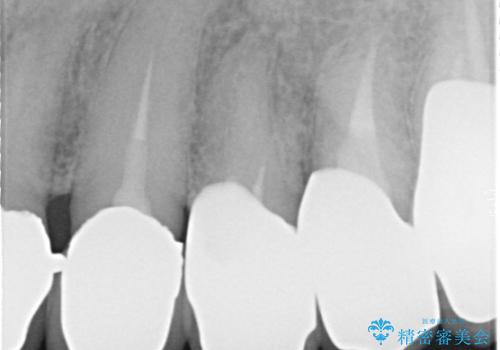 奥歯がなくてかめない 入れ歯とクラウンでの全顎治療の治療後