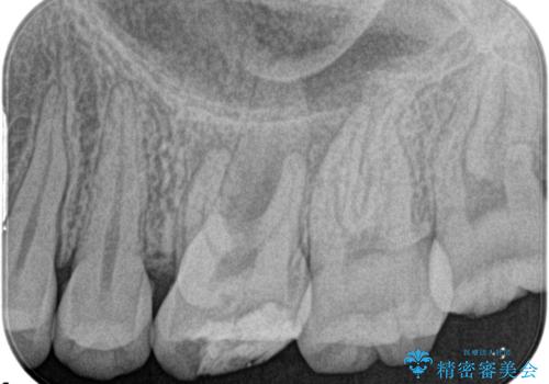 奥歯の根管治療の症例 治療前