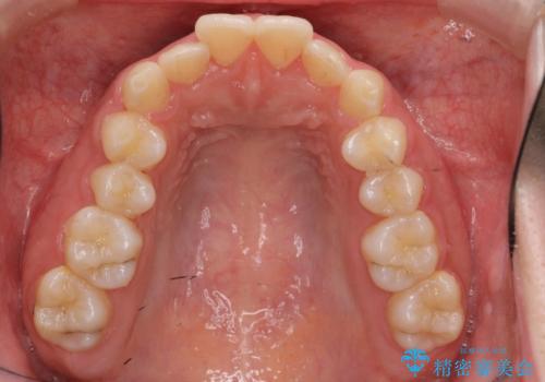マウスピース矯正 下顎前歯のがたつきの改善の治療前