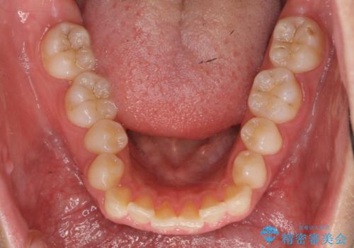 マウスピース矯正 下顎前歯のがたつきの改善の治療前