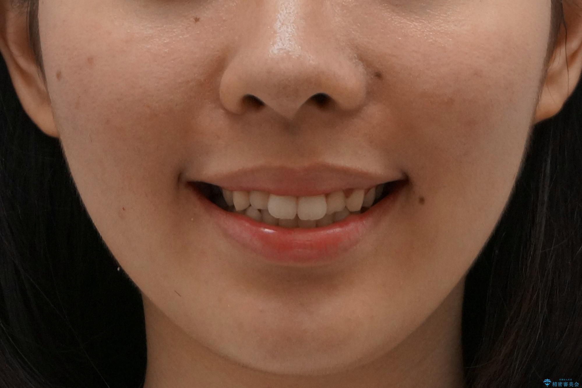 マウスピース矯正 下顎前歯のがたつきの改善の治療前(顔貌)