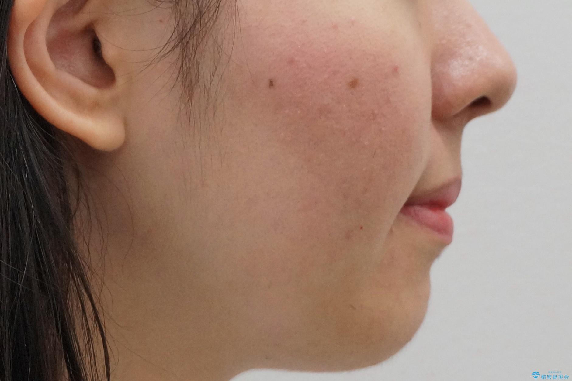 マウスピース矯正 下顎前歯のがたつきの改善の治療前(顔貌)