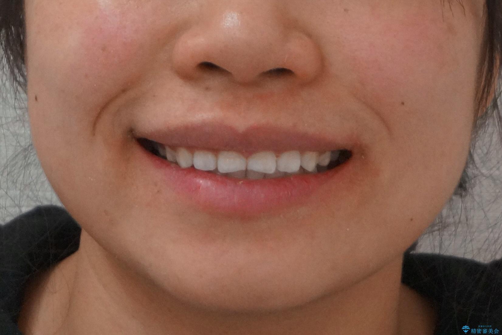 インビザライン 気になるすきっ歯の改善の治療後(顔貌)