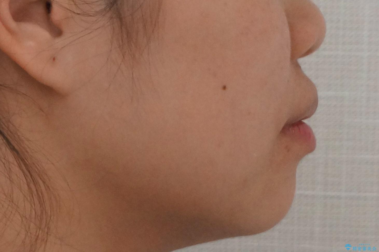 インビザライン 気になるすきっ歯の改善の治療後(顔貌)