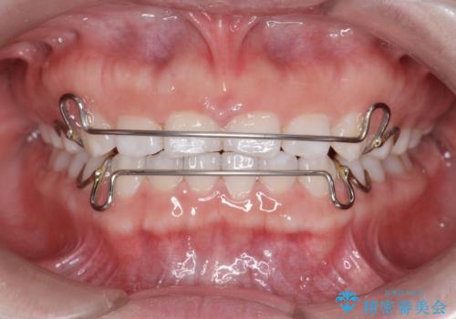 インビザライン 気になるすきっ歯の改善の治療後