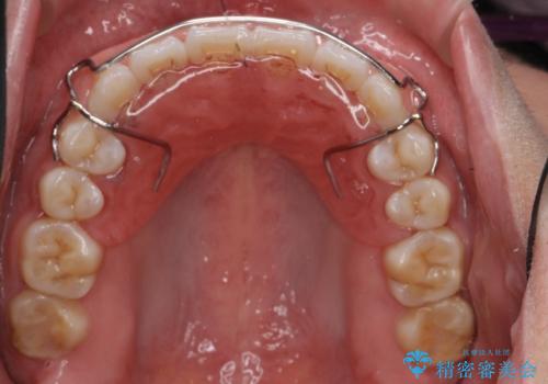 インビザライン 気になるすきっ歯の改善の治療後