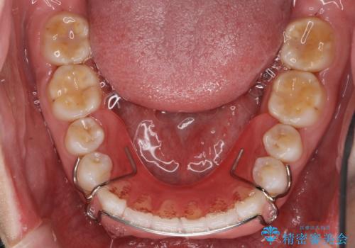 インビザライン 気になるすきっ歯の改善の治療後