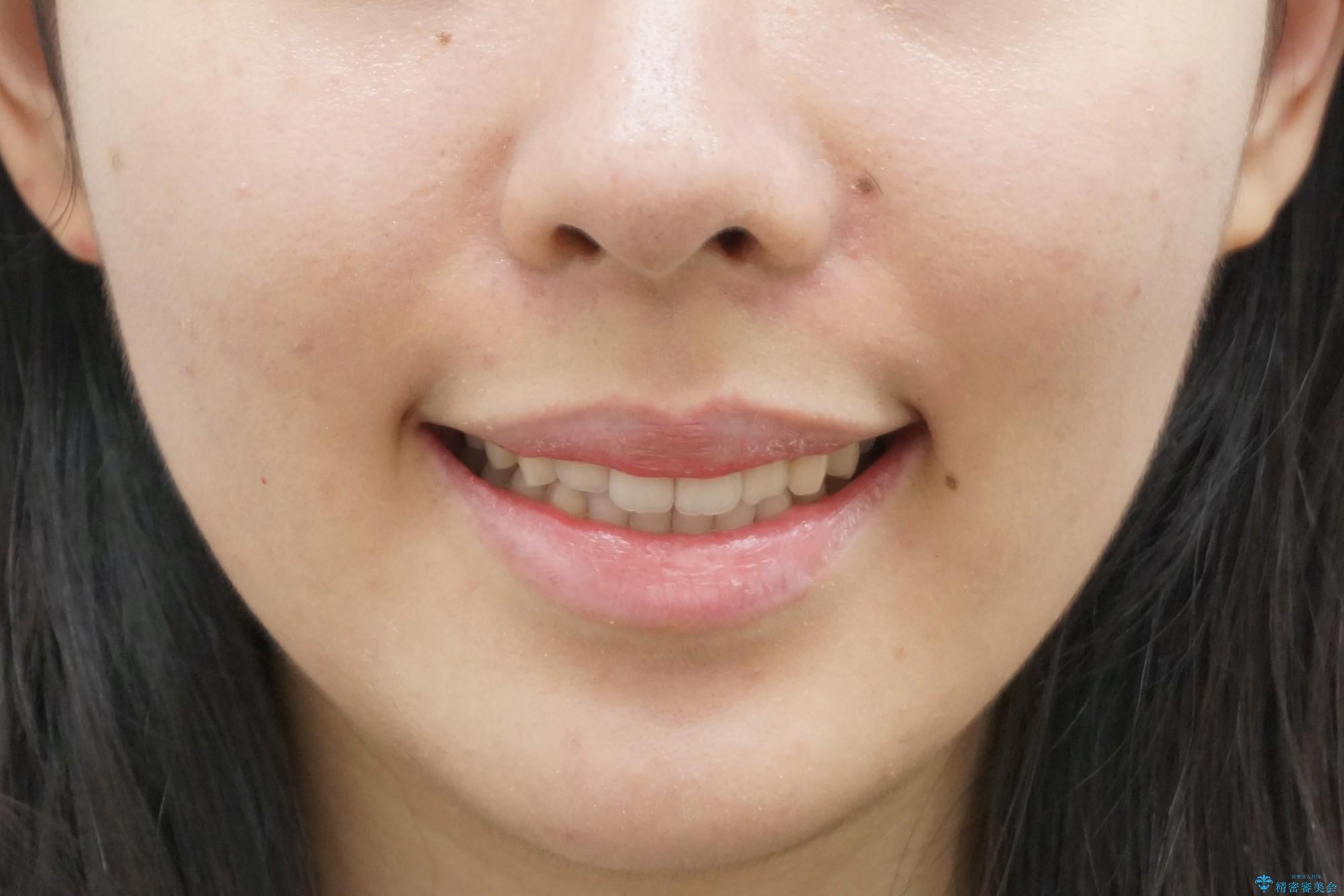 マウスピース矯正　下顎前歯のがたつきの改善の治療後（顔貌）