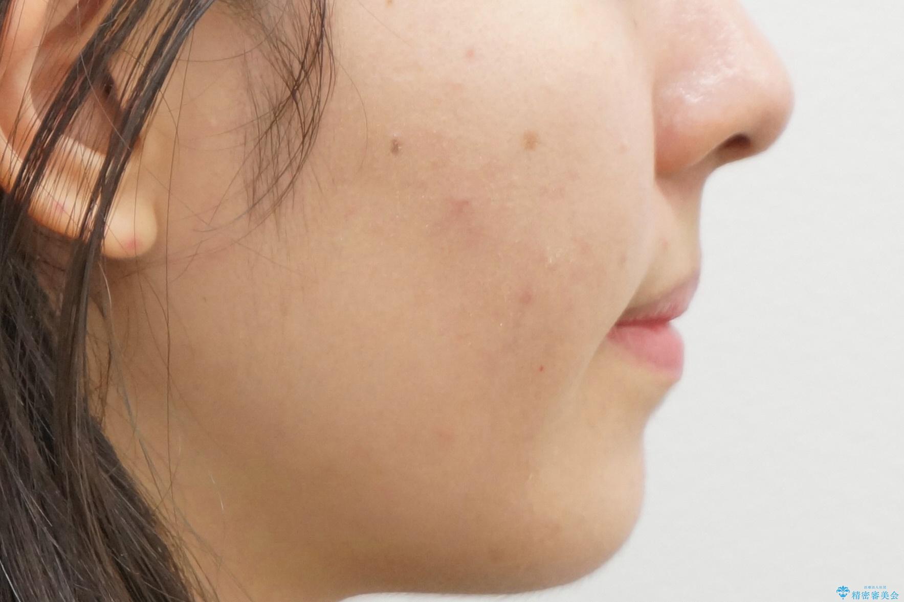 マウスピース矯正 下顎前歯のがたつきの改善の治療後(顔貌)