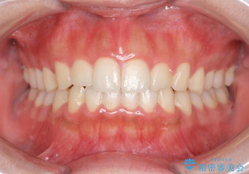 マウスピース矯正 下顎前歯のがたつきの改善の症例 治療後