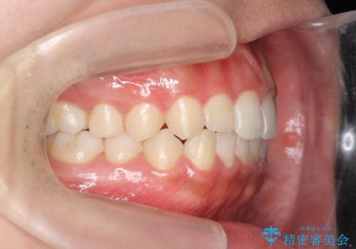 マウスピース矯正 下顎前歯のがたつきの改善の治療後