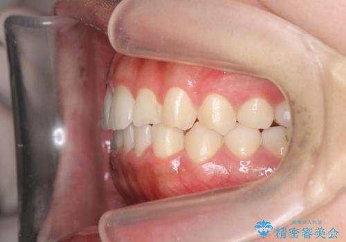 マウスピース矯正　下顎前歯のがたつきの改善の治療後