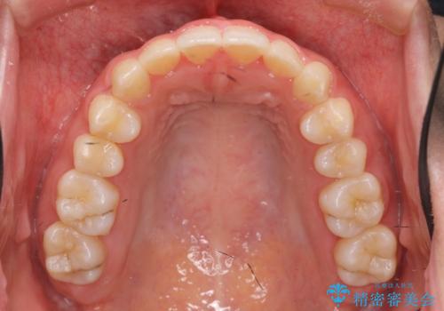 マウスピース矯正 下顎前歯のがたつきの改善の治療後