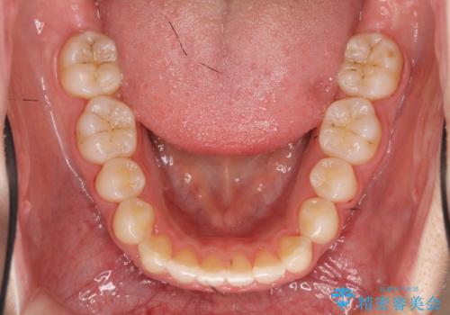 マウスピース矯正 下顎前歯のがたつきの改善の治療後