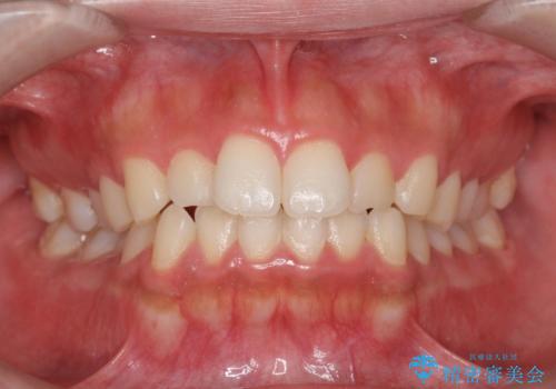 マウスピース矯正　下顎前歯のがたつきの改善の治療前