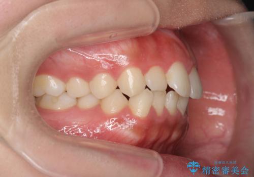マウスピース矯正　下顎前歯のがたつきの改善の治療前