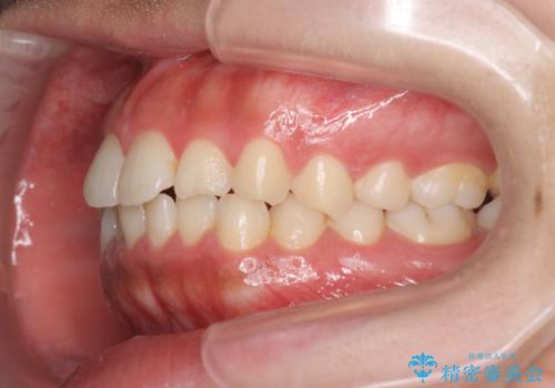 マウスピース矯正 下顎前歯のがたつきの改善の治療前