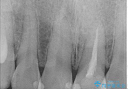 オールセラミッククラウン 長さが気になる前歯の改善の治療前