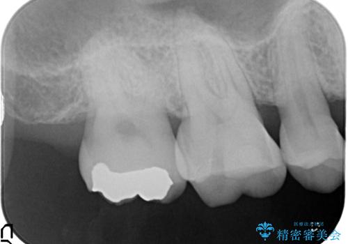 奥歯のゴールドインレーによる虫歯治療の治療前