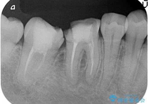 オールセラミッククラウン　欠けてしまった奥歯の治療の治療前