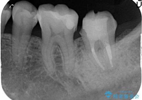 オールセラミッククラウン 痛みが引かない歯の治療の治療前