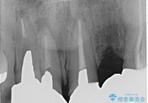 オールセラミッククラウン 気になる歯茎と被せ物の隙間の改善の治療前