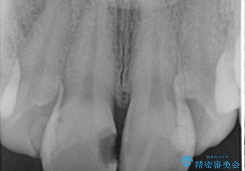 オールセラミッククラウン 長期間放置してきた前歯の虫歯治療の治療前