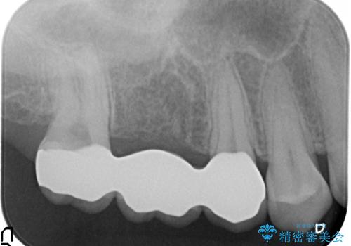 オールセラミッククラウン 奥歯のブリッジの治療後