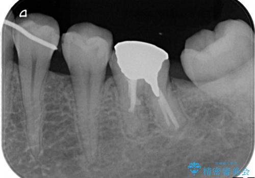目立つ銀歯を白くしたい セラミック治療の治療前