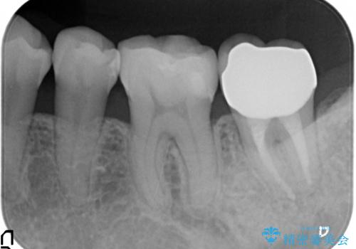 オールセラミッククラウン 痛みが引かない歯の治療の治療後