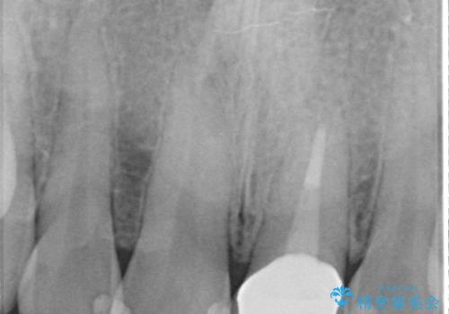 オールセラミッククラウン 長さが気になる前歯の改善の治療後