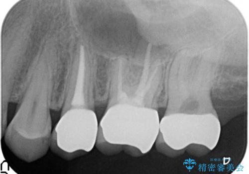 オールセラミッククラウン 痛みでものが咬めない歯の治療の治療後