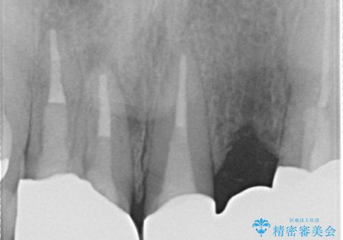 オールセラミッククラウン 気になる歯茎と被せ物の隙間の改善の治療後